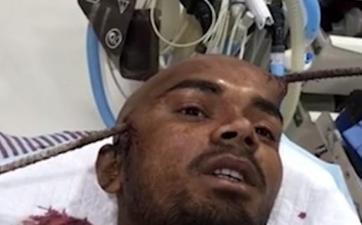 Una barra de hierro le atravesó la cabeza y sobrevivió de milagro