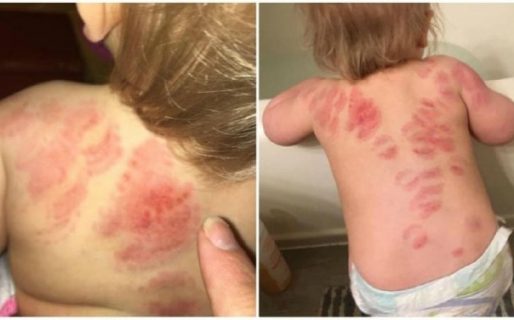 Espeluznante: Niña sufrió más de 25 mordeduras en una guardería