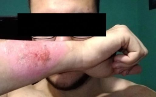 Se hizo un tatuaje y a la semana se lo borró con un rallador de queso