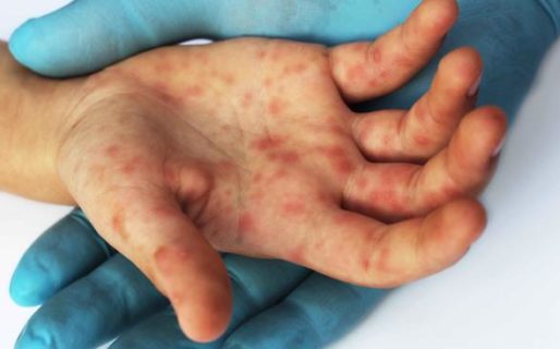 Salud afirma que nunca faltaron ni faltarán vacunas contra el sarampión