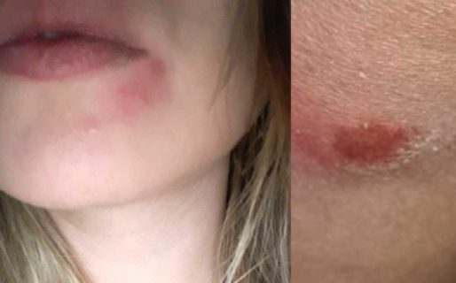 Joven golpeada en un robo en Km. 8 advirtió: ‘no salgan a la calle solas’