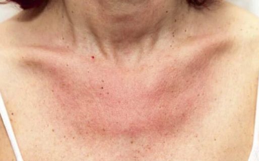 Las cinco manifestaciones del COVID-19 en la piel