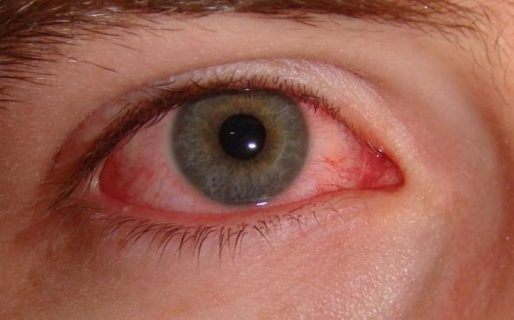 Detectan la causa por la que ingresaría al organismo a través de los ojos