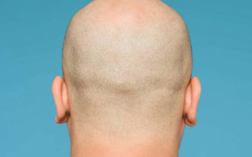 Afirman que los hombres con calvicie tienen un 40% más de probabilidades de padecer síntomas graves