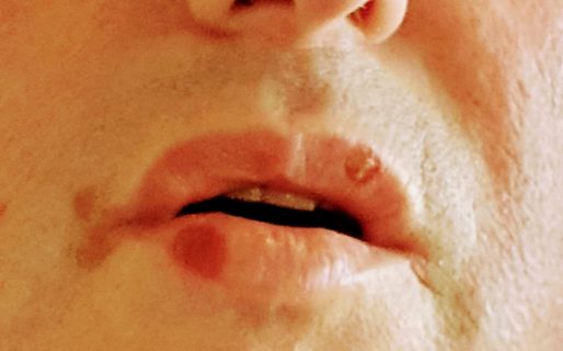 El Covid le provocó ampollas en la piel y boca a un médico comodorense: “Es un virus con muchos puntos de ataque”