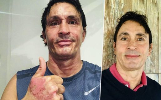El estremecedor relato de Sebastián Estevanez del feroz accidente que le quemó la cara y el cuerpo: “No soportaba el dolor”