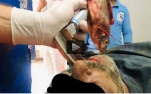 Le extrajeron un pez vivo de la garganta a un pescador