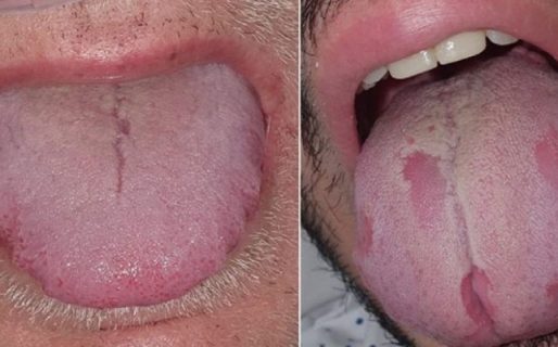 Los nuevos síntomas de coronavirus que se manifiestan en lengua y manos