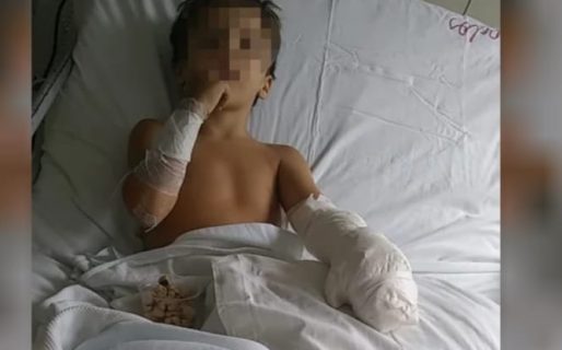 Piden con urgencia un sustituto dérmico Integra para un niño que sufrió graves quemaduras