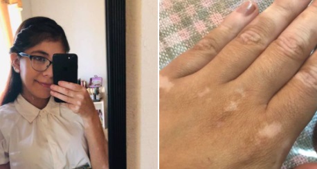 La mala experiencia de una joven con vitíligo y su mensaje concientizador