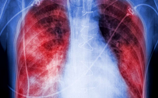 Qué es la neumonía bilateral y qué produce en el cuerpo