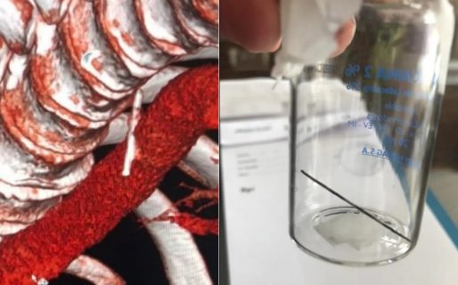 Se tragó una aguja al comer un sándwich pero le salvaron la vida