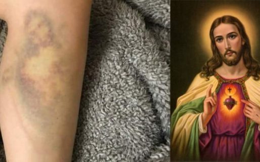 Se cayó de la bicicleta y le salió un moretón con la silueta de Jesús