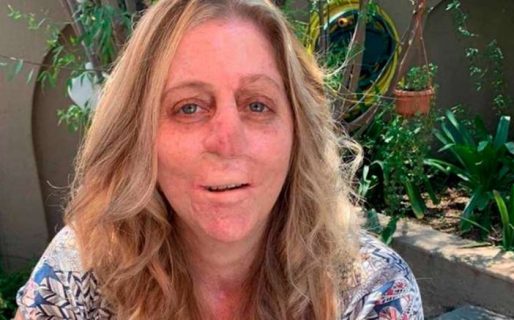 El drama de la mujer que perdió la nariz, los labios, la lengua, las manos y los pies por la mordida de una mangosta