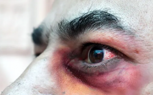 Primer muerto por «hongo negro» en Argentina