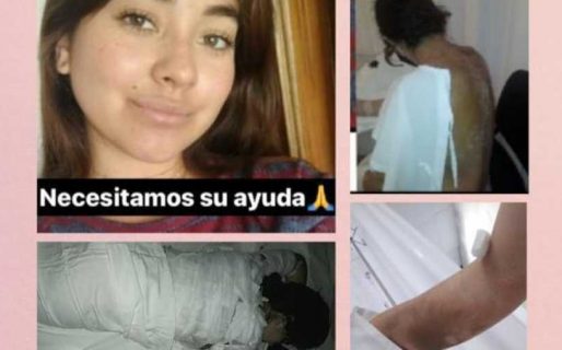 Una estudiante comodorense se quemó el 40% del cuerpo y piden colaboración