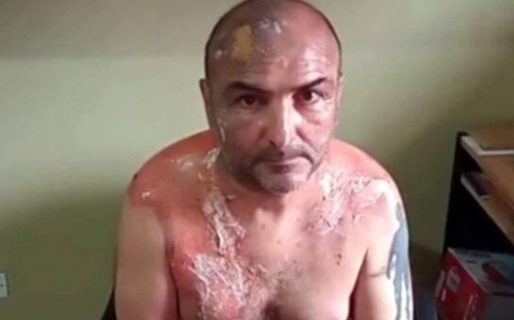 Denunció que su ex mujer le tiró agua hirviendo durante la separación