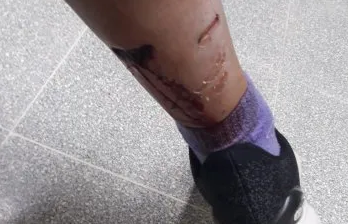 Feroz ataque de un Pitbull hacia una mujer, a la que le destrozó una pierna