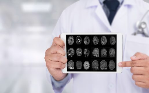 Un estudio arrojó resultados esperanzadores sobre un nuevo tratamiento contra el Alzheimer