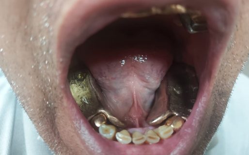 Insólito: dos hombres fueron detenidos por tráfico de oro: lo escondían entre sus dientes