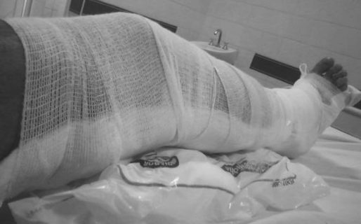 Chaco: enyesaron a un paciente con cartones ante la falta de insumos