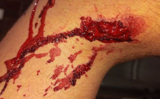 Dos perros atacaron a un chico de 15 años en el barrio Juan XXIII