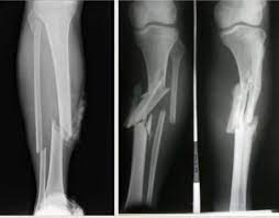 La señora que fue derribada por un perro en Km.3 fue operada con éxito: le colocaron dos placas y nueve tornillos