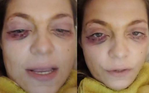 Tamara Paganini apareció con el rostro lleno de moretones y preocupó a sus seguidores