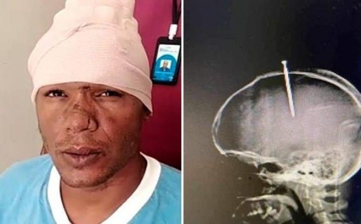 Tenía un clavo en la cabeza, pero no se enteró por estar muy drogado
