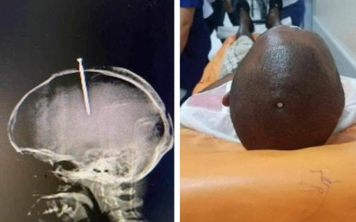 Estaba tan drogado que no se dio cuenta que tenía un clavo en su cabeza