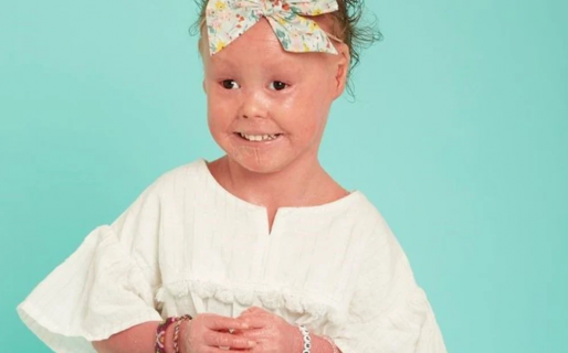 Tiene 6 años, una rara enfermedad de la piel y consiguió su primer trabajo como modelo