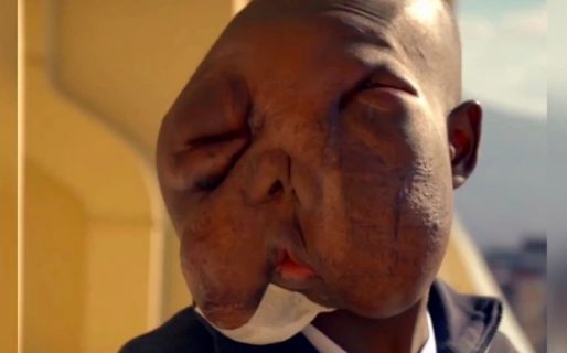 Padecía un extraño tumor que le desfiguró la cara, su mamá lo abandonó, encontró la cura y luce su nuevo rostro