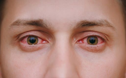 Detectaron un nuevo síntoma de coronavirus que afecta a los ojos