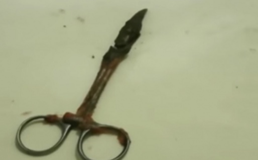 Le sacaron una tijera del estómago tras 20 años: sufría fuertes dolores abdominales