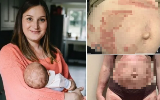 El dramático caso de la mujer que es alérgica a su propio hijo