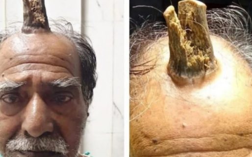 Sufrió un golpe en la cabeza y le creció durante años un “cuerno del diablo”