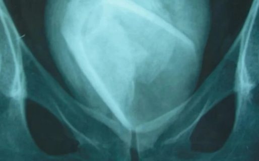 Creyó tener una infección urinaria pero era un objeto atascado en su vejiga tras un osado juego sexual hace cuatro años