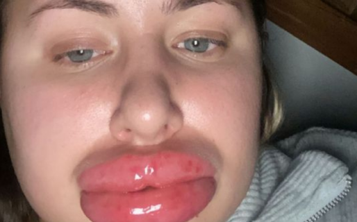 Sufrió una reacción alérgica y sus amigas la comparan con un personaje de Monsters Inc