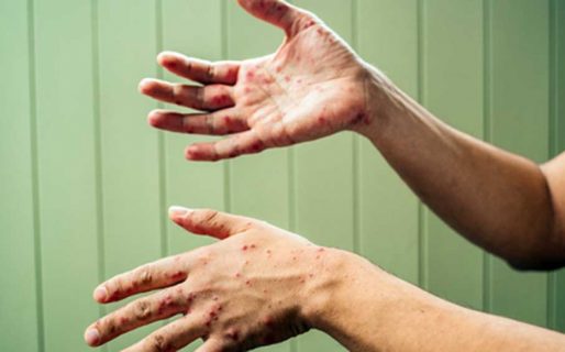 Detectaron un posible caso de sarampión en el país