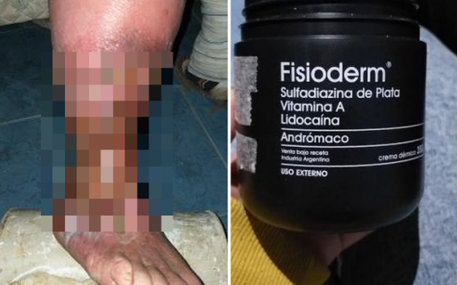 Padece úlceras con trombosis y tras 8 años de tratamientos solo una crema alivia su dolor: cómo ayudar a Eva