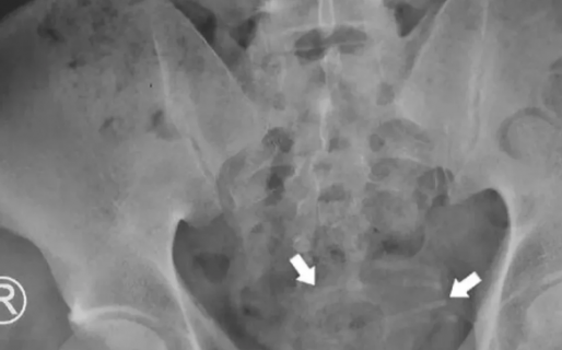 No podía hacer pis, los médicos se sorprendieron con lo que tenía