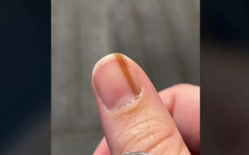 Descubrió una mancha en su uña y 10 años después la operaron por cáncer