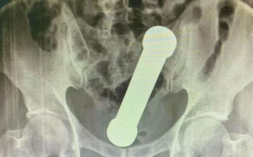 Terminó en la guardia tras un peligroso juego sexual: lo operaron para extraerle una mancuerna