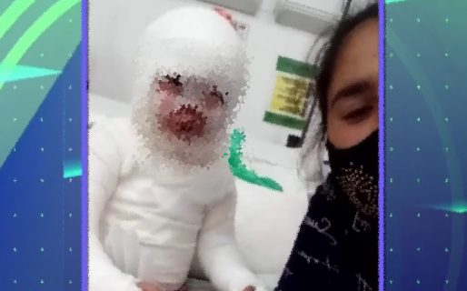 Una empleada de un restaurante le volcó aceite hirviendo a una nena de 3 años