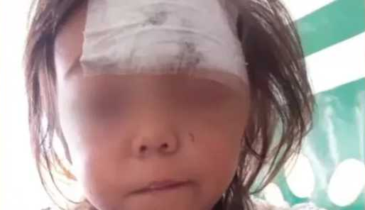 Un pitbull le desfiguró la cara a una nena de 2 años