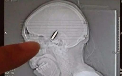 Se accidentó en su moto, le hicieron una placa y le detectaron una bala en la cabeza