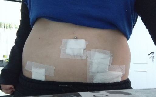 Fue al hospital con vómitos y dolor en el abdomen, la diagnosticaron erradamente y casi pierde la vida