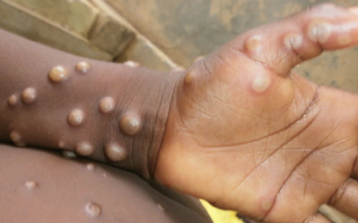 Alerta por la viruela del mono: 23 casos sospechosos en Madrid