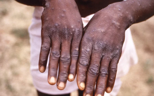 Confirman la detección del primer caso sospechoso de viruela del mono en la Argentina