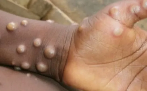 Viruela del mono: la OMS confirma 780 casos en 27 países